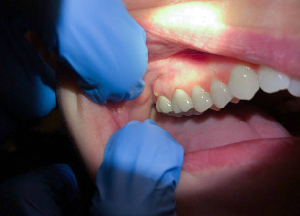 Best Emergency Care for Gum Disease in Big Bend, WI